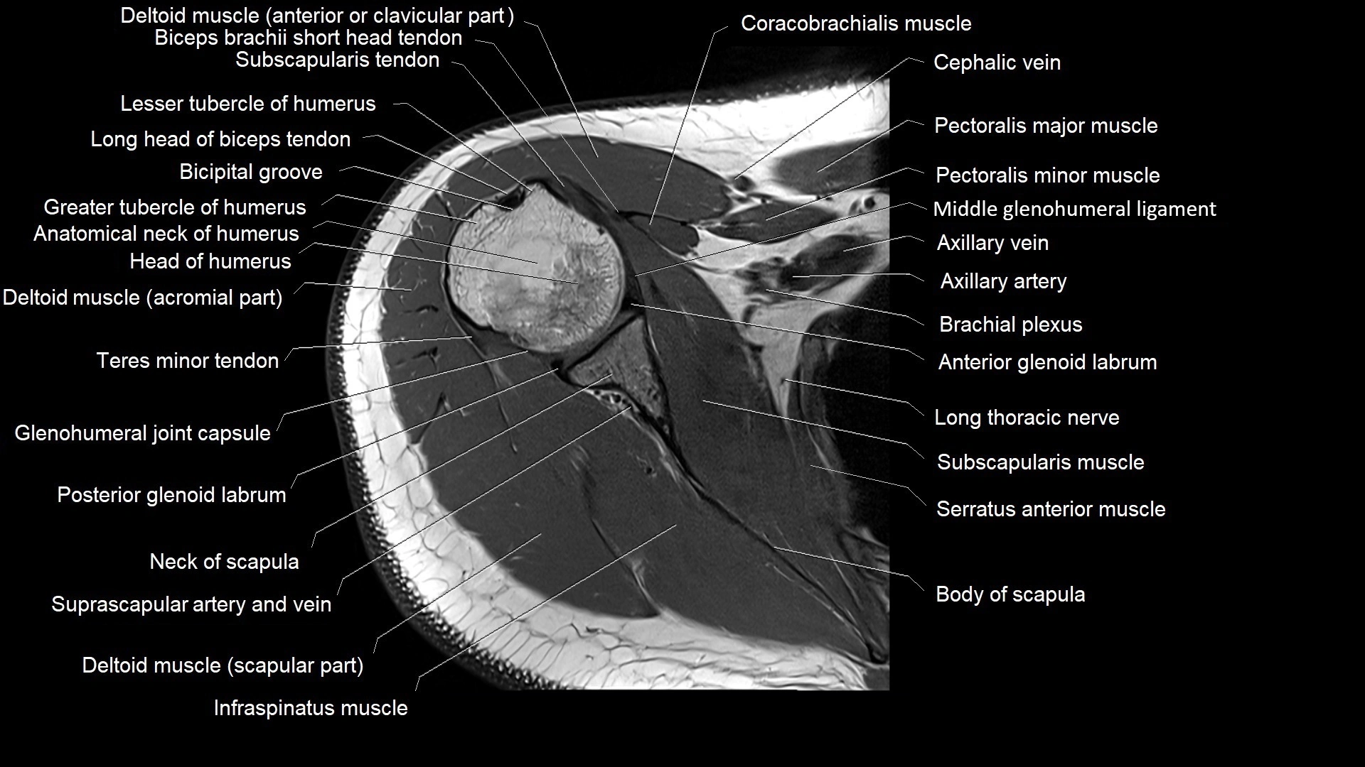 Shoulder cross sectional anatomy MRI 3T axial image 20.webp